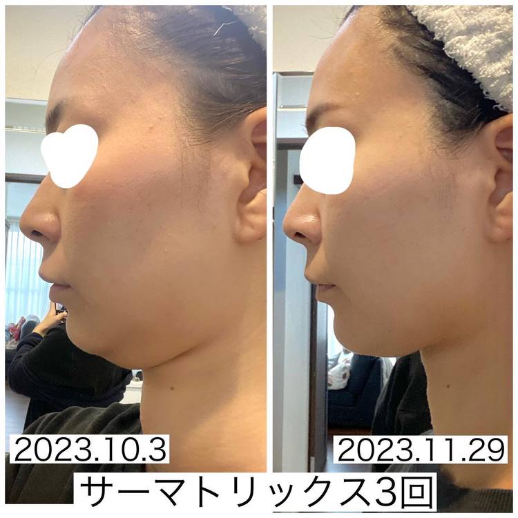 姫路で唯一のたるみケア「サーマトリックス」 | 【50歳からの