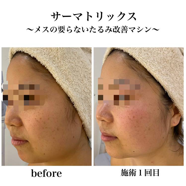 姫路で唯一のたるみケア「サーマトリックス」 | 【50歳からの