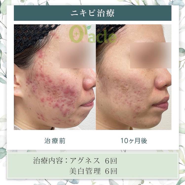 Mixed media feed | オラクル美容皮膚科 | LINE Official Account